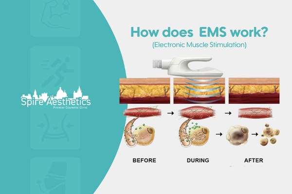EMS treatment for post pregnancy weight loss treatment East Retford