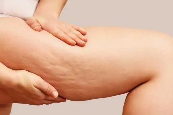 Image of woman showing leg with cellulite East Retford