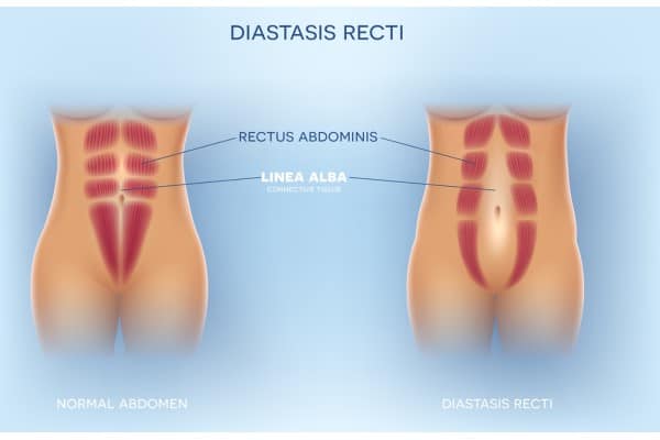 What Non-Surgical Options Are Available for Diastasis Recti East Retford?