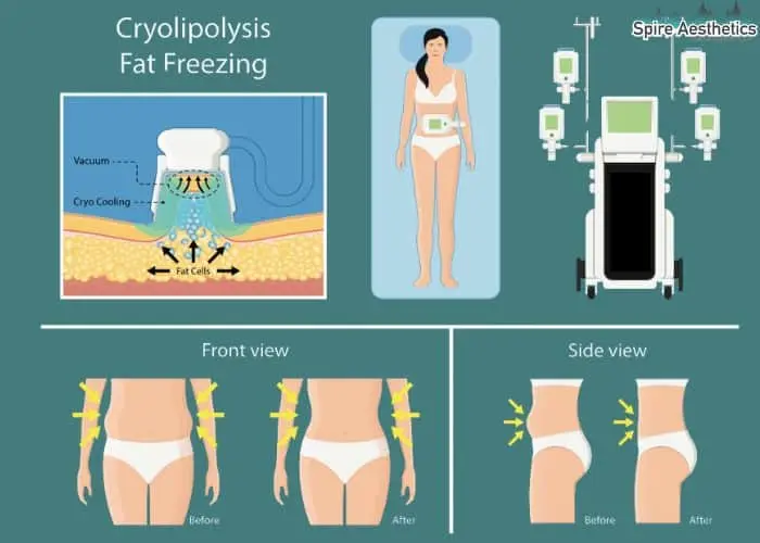 Fat freezing treatment East Retford benefits for competitions to remove stubborn fat deposits.