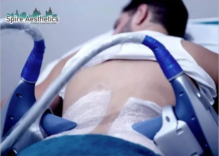 Man having fat freezing treatment done on love handles before a competitions East Retford to create a sculpted look.