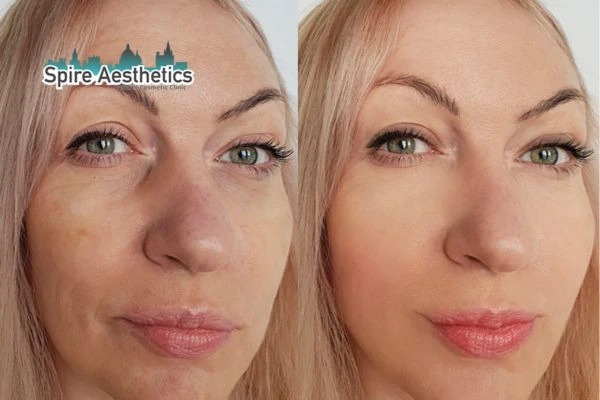Morpheus8 Treatment East Retford Before & After Results