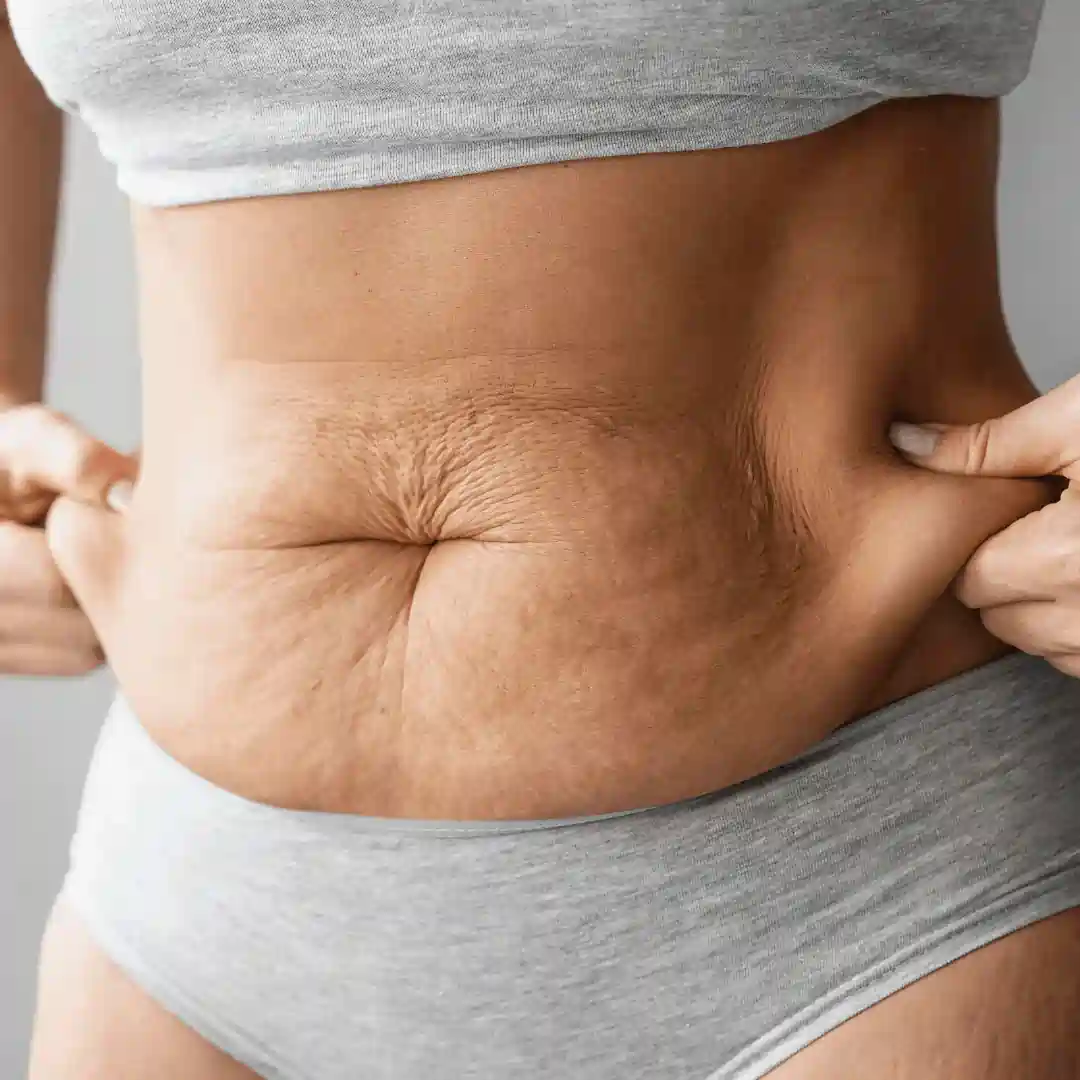 Is It Normal to Have Loose Skin After Pregnancy East Retford?