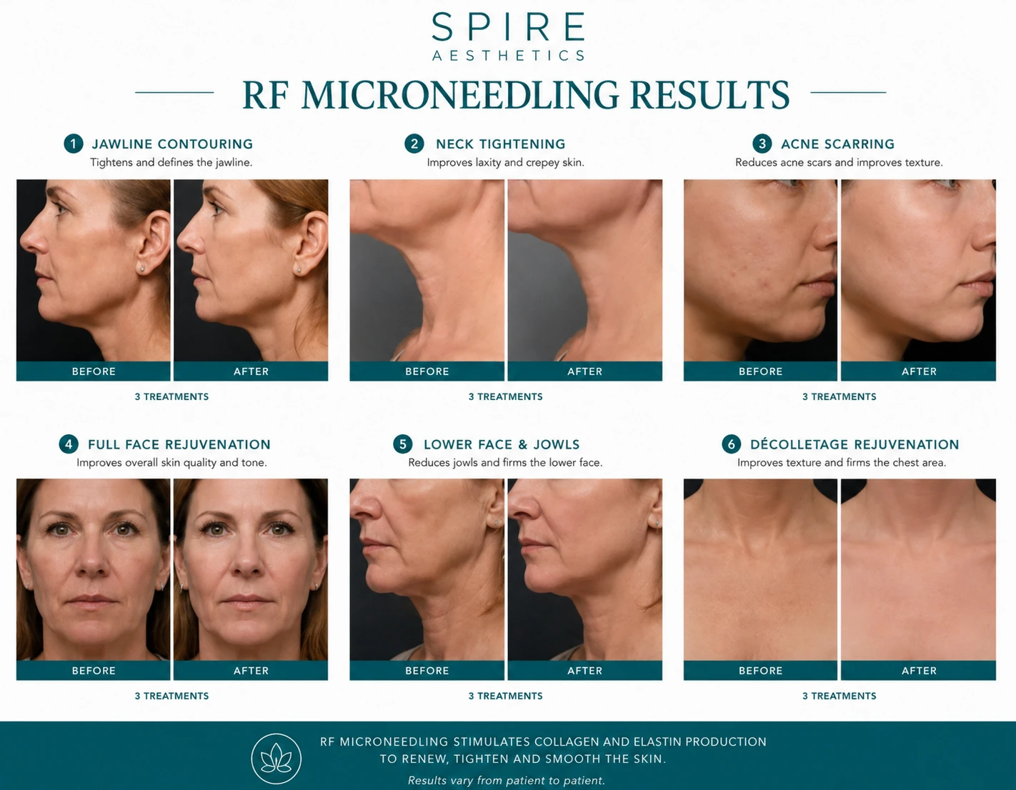 RF Microneedling Skin tightening East Retford results