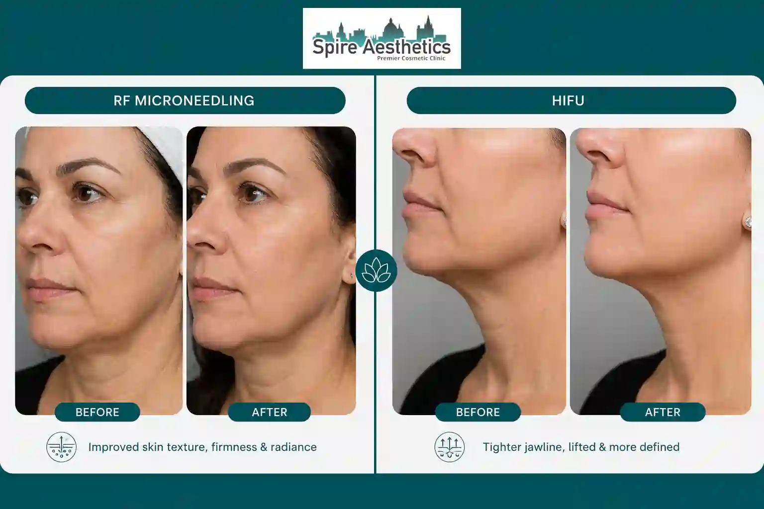 Can RF Microneedling and HIFU Be Combined East Retford?