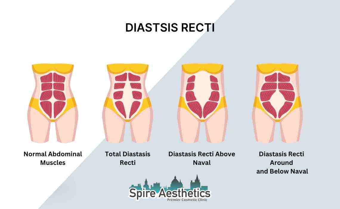 Is Non-Surgical Diastasis Recti Treatment Right for You? Common Concerns Answered East Retford